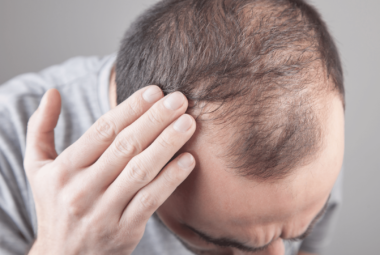 Understanding Hair Loss: A Man's Guide to Balding and Hair Treatments