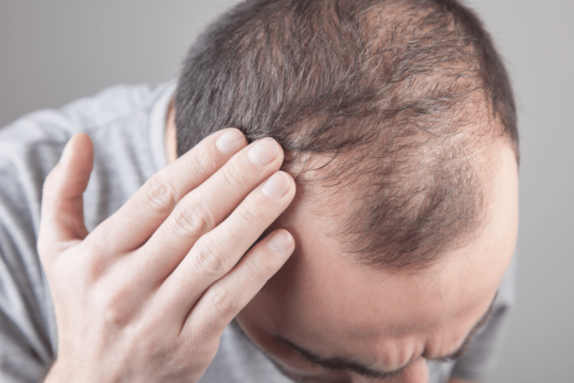 Understanding Hair Loss: A Man's Guide to Balding and Hair Treatments